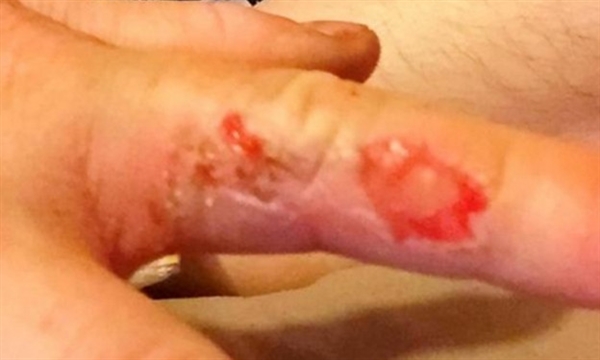 索尼手機也爆炸了:機主被燒慘
